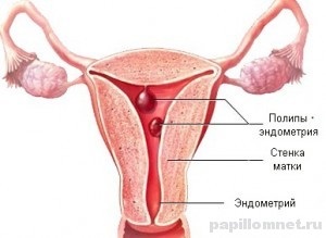 Prezentare generală a îndepărtării cu laser a polipului în uter