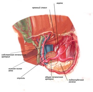 Tumorile spațiului retroperitoneal, tratamentul și prevenirea cancerului