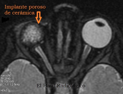 Orgital patologie