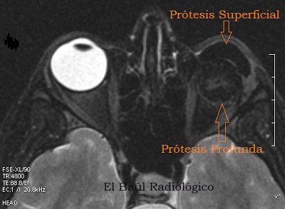 Orgital patologie