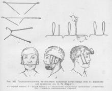 Tratamentul ortopedic al fracturilor maxilarului maxilar, stomatologie ortopedică