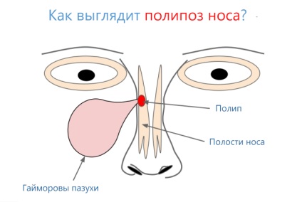 Cauze ale polipilor în nas și complicații periculoase