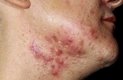 Cauze de acnee la nivelul gâtului la femei și bărbați