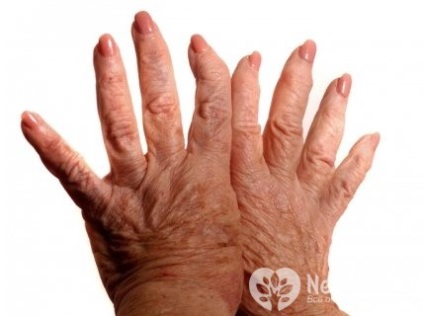 Rheumatoid arthritis - kezelésére, a tünetek, prognózis