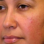 Rosaceea asupra simptomelor feței, a cauzelor, a fotografiilor și a tratamentului