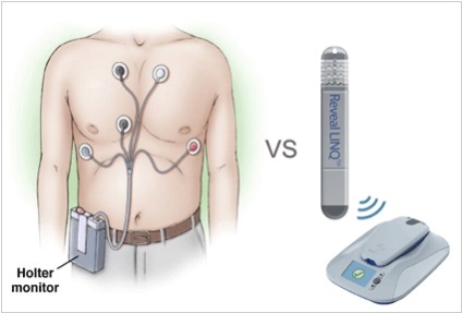 Szívbetegségek implantátumok - áttekintést livemd