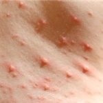 Sindrofie roseola