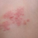 Sindrofie roseola