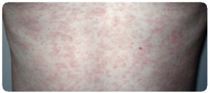 Sindrofie roseola