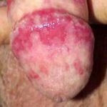 Sindrofie roseola