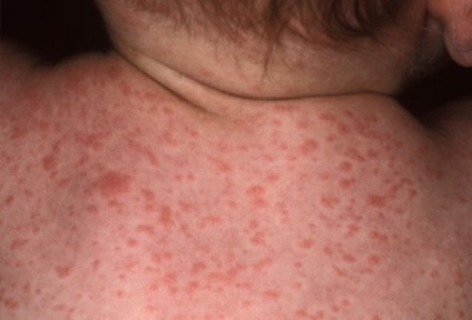 Simptomele roseoli sifiliene