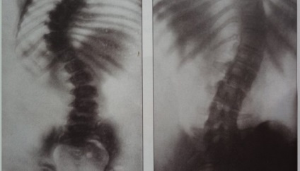 Scolioza coloanei vertebrale lombare de 1 grad