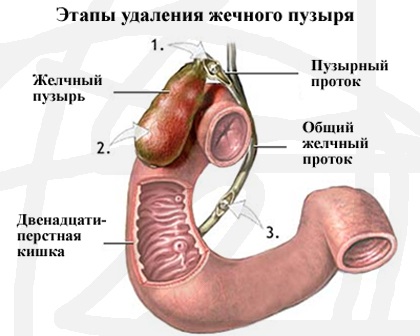 Cât de mult o operațiune de eliminare a vezicii biliare, ce și cât este