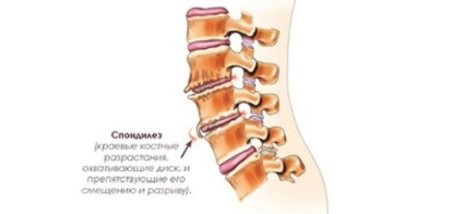 Spondiloza cauzează, simptome, tratament