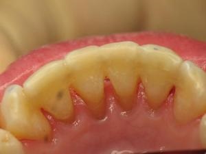 Tehnologia-gumă de tratament-ceea ce este parodontita?