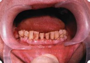 Tehnologia-gumă de tratament-ceea ce este parodontita?