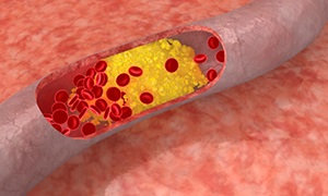 Traheobronchitis - simptome, cauze, tratament