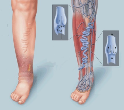 Thromboembolia alsó végtagok vagy az erek elzáródása és az artériák a lábak