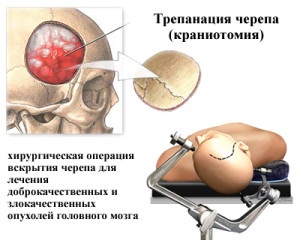 Eliminarea unei tumori cerebrale, a cancerului - tratament și prevenire