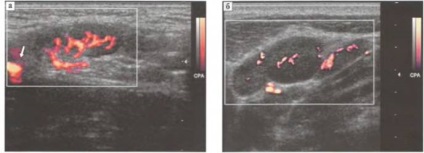 Uz-semiotica bolilor - investigarea ganglionilor limfatici cu ultrasunete