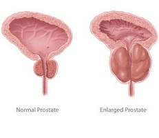 Nu știți cum să tratați prostatita și adenomul