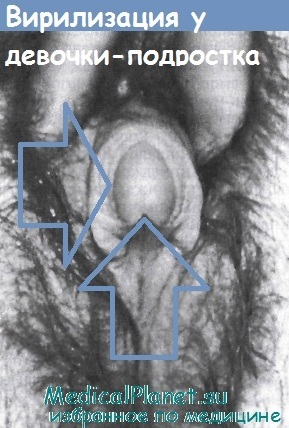 Virilizare - diagnostic, tratament