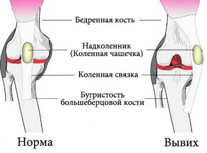 Dislocarea genitală patelară