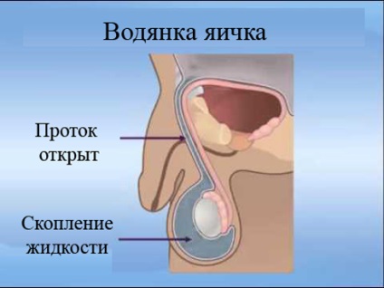 Dropsy of testicles la sugari și tratament, en-babyhealth