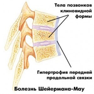 Cifoza juvenilă (boala lui sheyerman-mau) - tratamentul durerii în clinica Dr. Ignatiev
