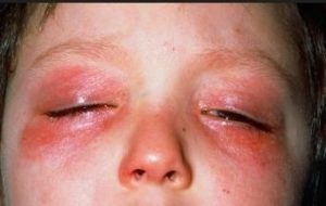 Allergiás duzzanat fenyegetések és segít az allergiás