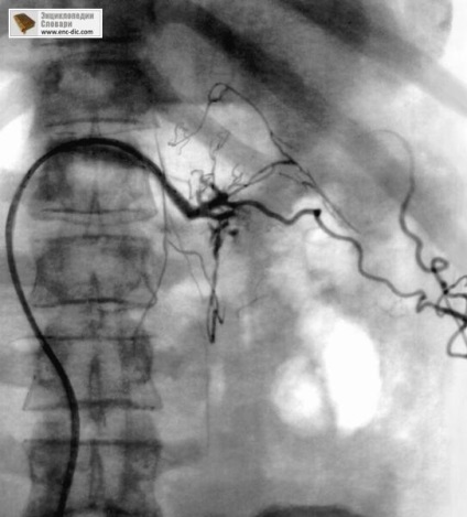 Angiografie - enciclopedie medicală - enciclopedii & amp; dicționare