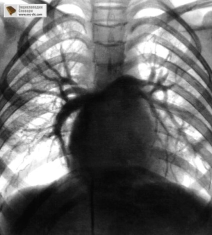 Angiografie - enciclopedie medicală - enciclopedii & amp; dicționare