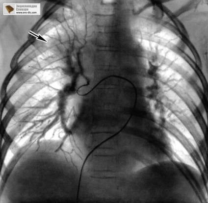 Angiografie - enciclopedie medicală - enciclopedii & amp; dicționare