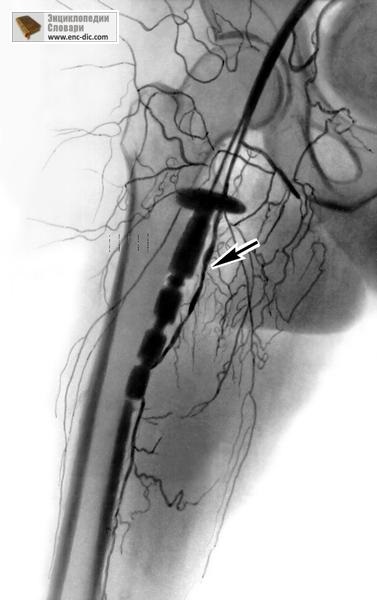 Angiografie - enciclopedie medicală - enciclopedii & amp; dicționare