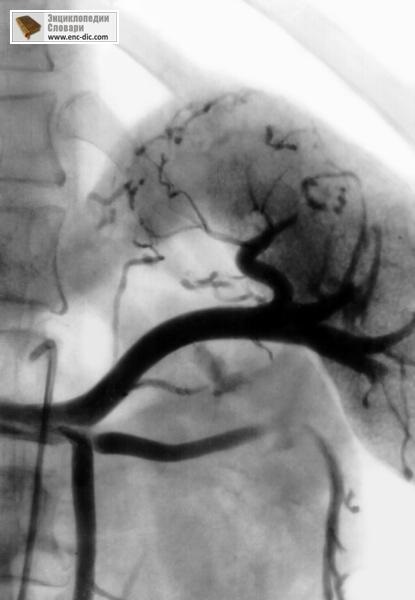 Angiografie - enciclopedie medicală - enciclopedii & amp; dicționare