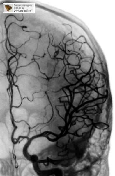 Angiografie - enciclopedie medicală - enciclopedii & amp; dicționare