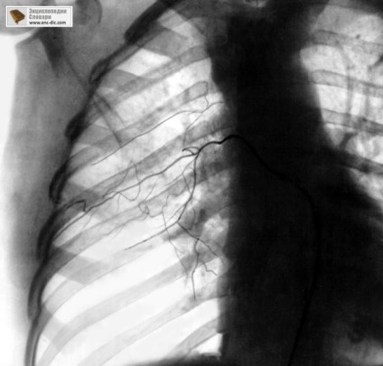 Angiografie - enciclopedie medicală - enciclopedii & amp; dicționare