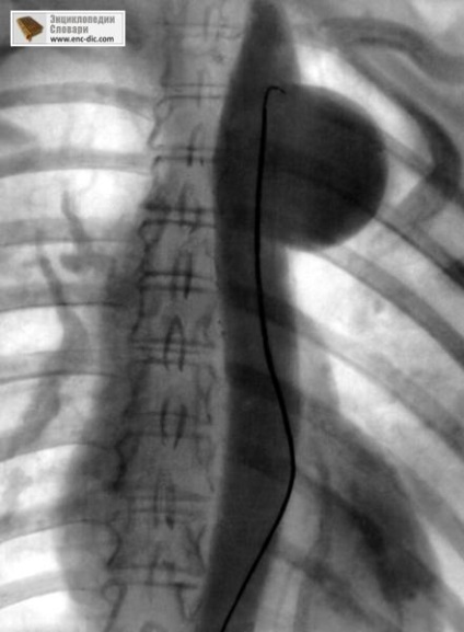 Angiografie - enciclopedie medicală - enciclopedii & amp; dicționare