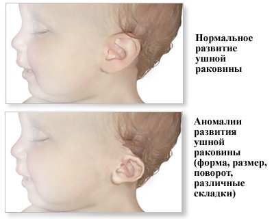 Anomalii ale urechii externe și ale urechilor inferioare