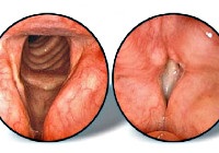 Anomalii ale dezvoltării laringelui - cauze, simptome, diagnostic și tratament