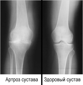 Osteoartrita, coxartroza