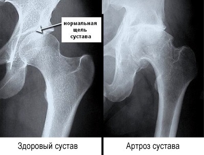 Osteoartrita, coxartroza