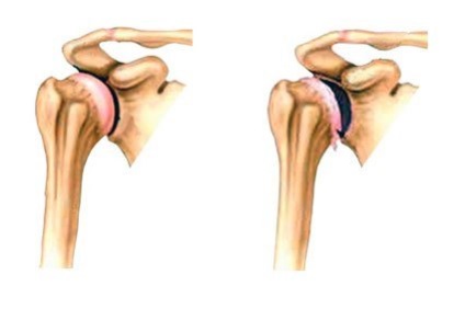 Osteoarthritis a vállízület okok, tünetek, kezelés