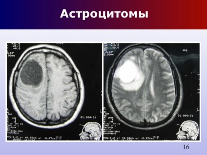 Astrocitomul creierului anaplazic, fibrilar, pilocitar, piloidal, difuz