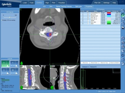 Astrocitomul tratamentului măduvei spinării, diagnostic, simptome - spizko clinică