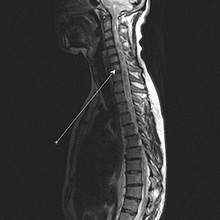 Astrocitomul maduvei spinarii - tratament in clinica din Moscova