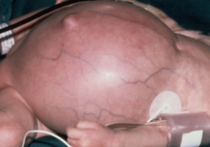 Ascite ale cavității abdominale cu oncologie, stomac și cancer intestinal, carcinomatoză peritoneală - prognostic,