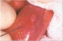 Biopsia formării buzelor patologice