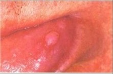Biopsia formării buzelor patologice