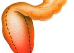 Usturoiul din diaree a ajutat intestinele